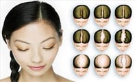  How to Re-grow hair on bald head ?